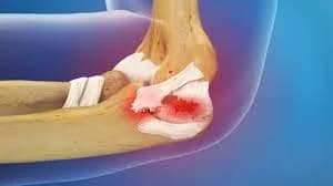 WHAT YOU SHOULD KNOW ABOUT UCL INJURY