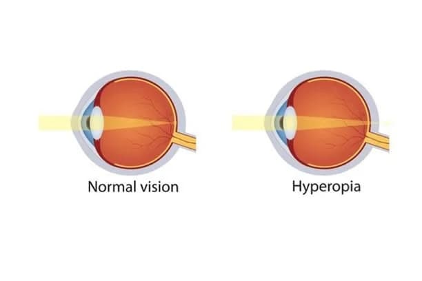 Hyperopia: Indwara y'Amaso ituma uyirwaye areba Kure Gusa.