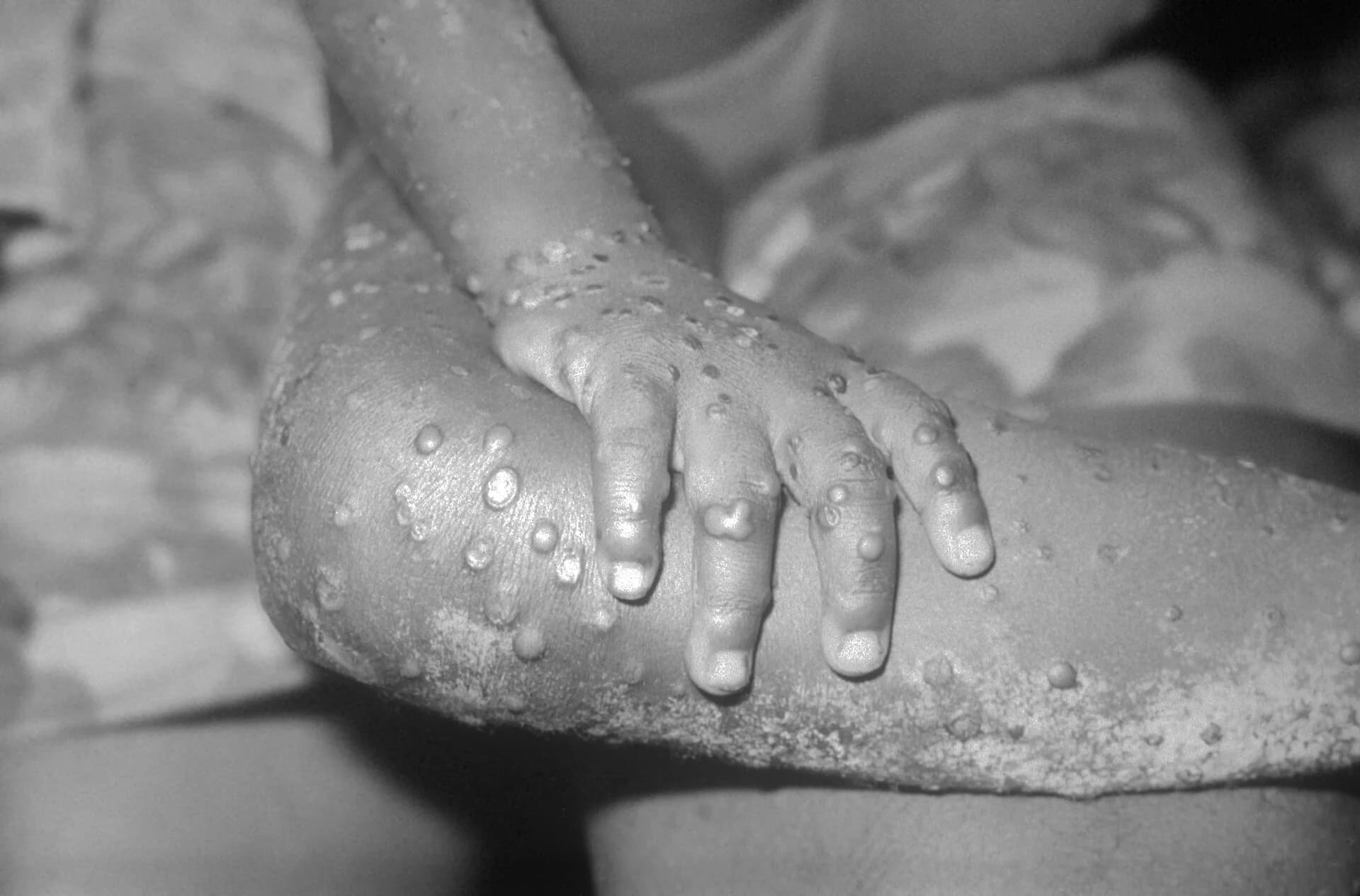 Byinshi wamenya kundwara ya mpox ikomeje kwibasira bimwe  mubihugu by'Afurika.